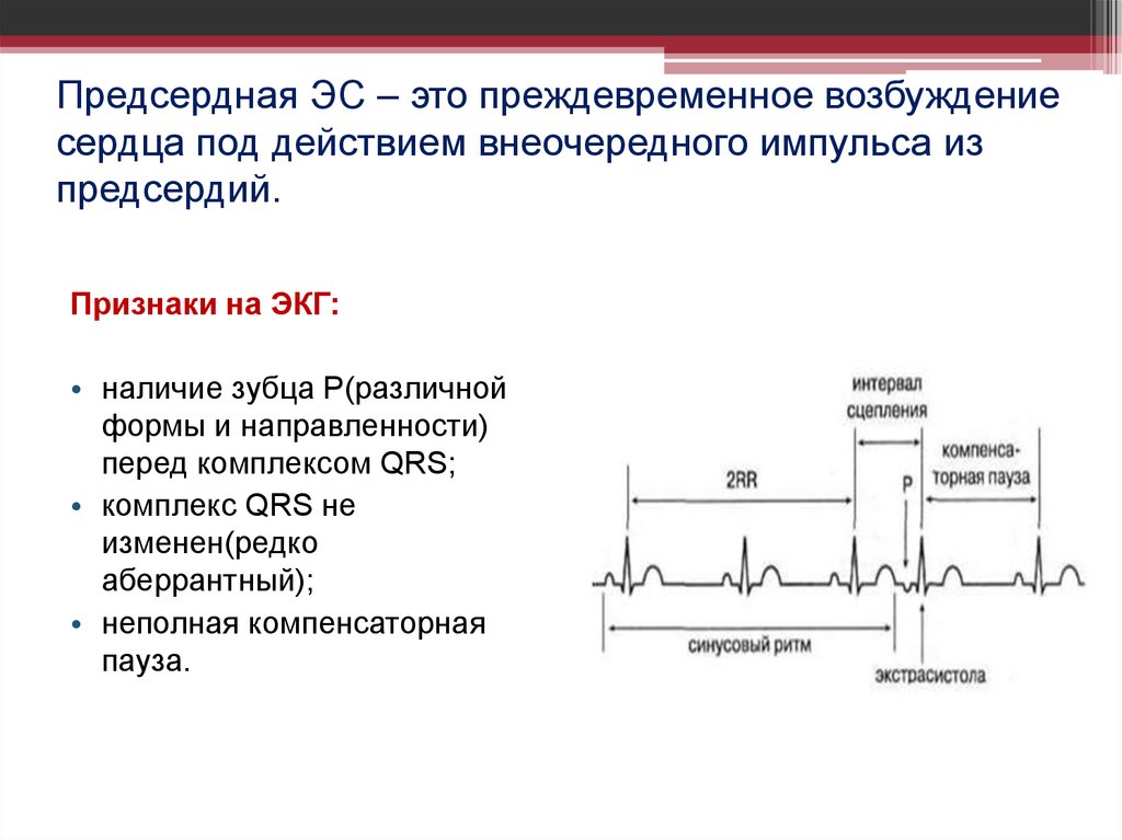 Предсердная ЭС – это преждевременное возбуждение сердца под действием внеочередного импульса из предсердий.