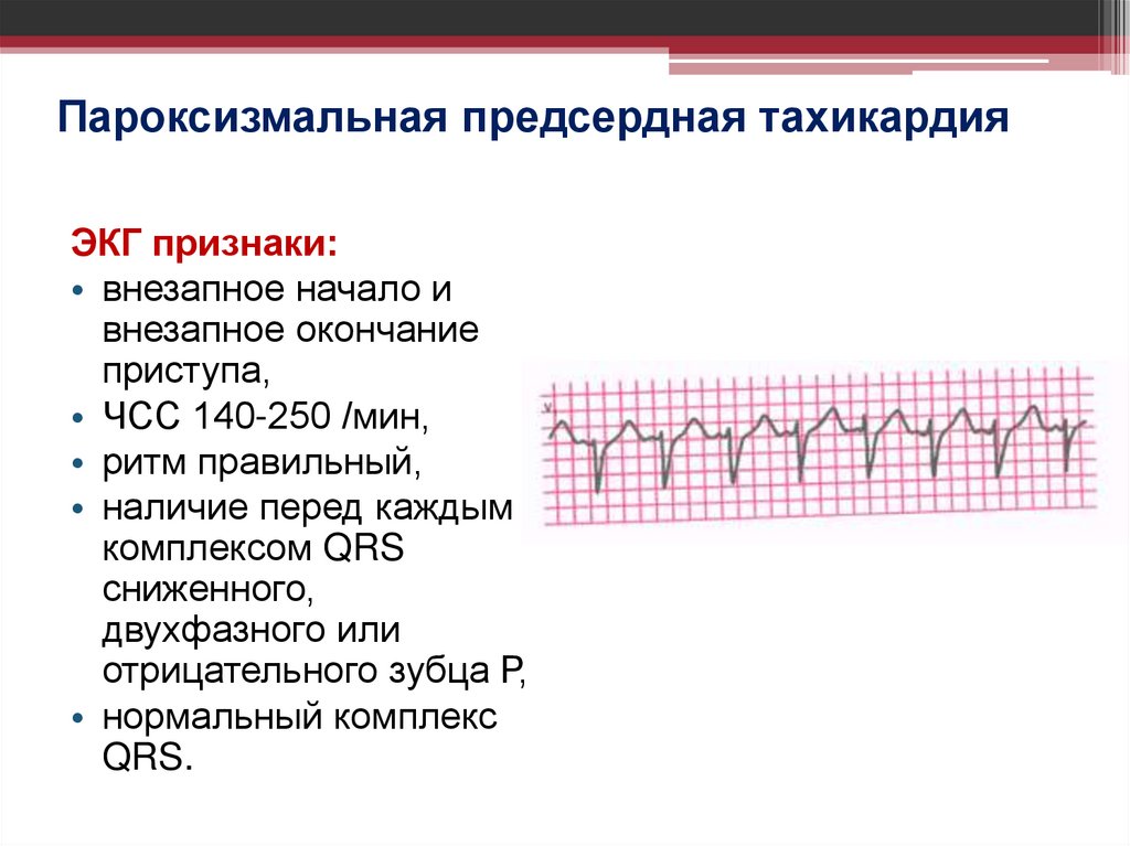 Пароксизмальная предсердная тахикардия