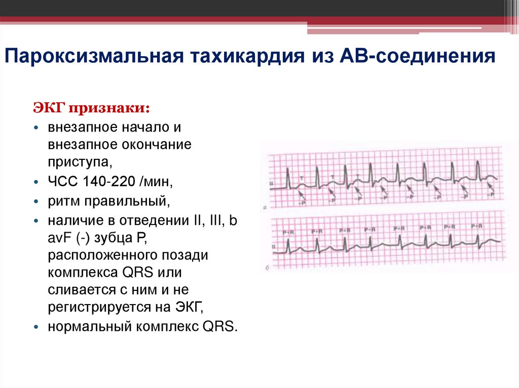 Пароксизмальная тахикардия из АВ-соединения