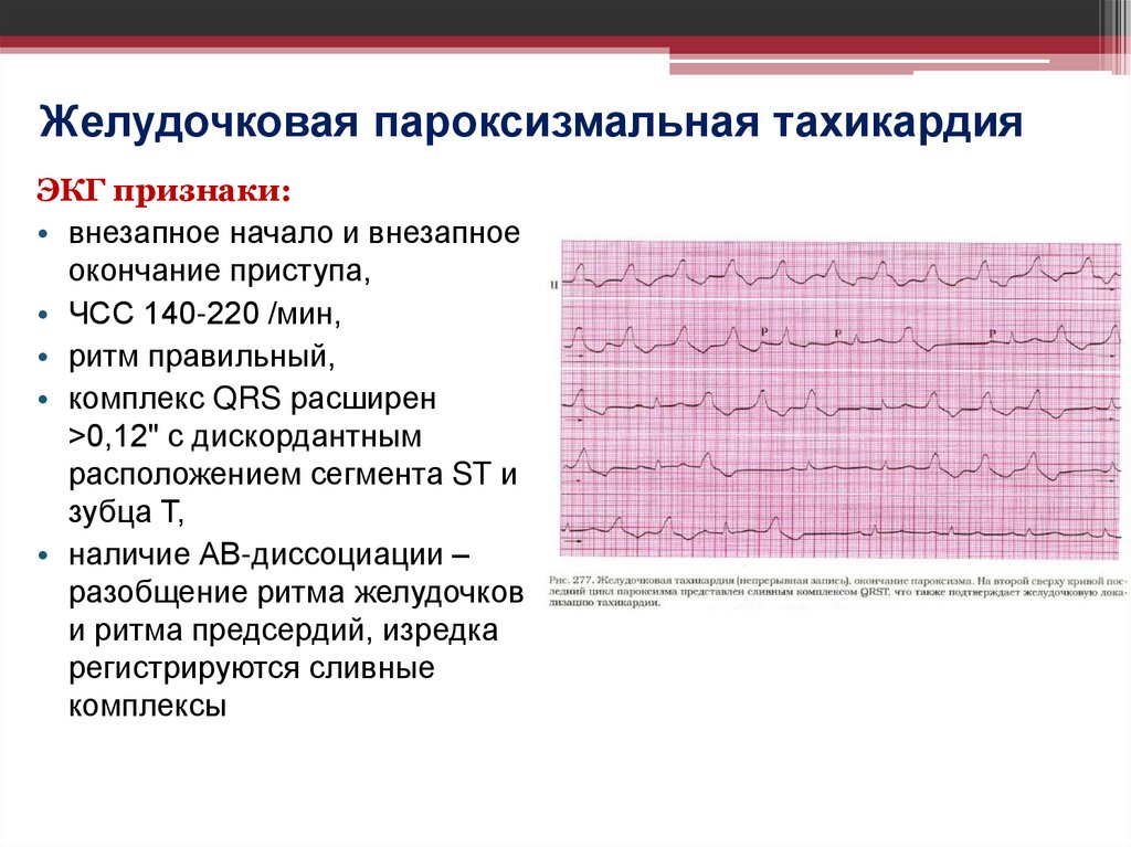 Желудочковая пароксизмальная тахикардия