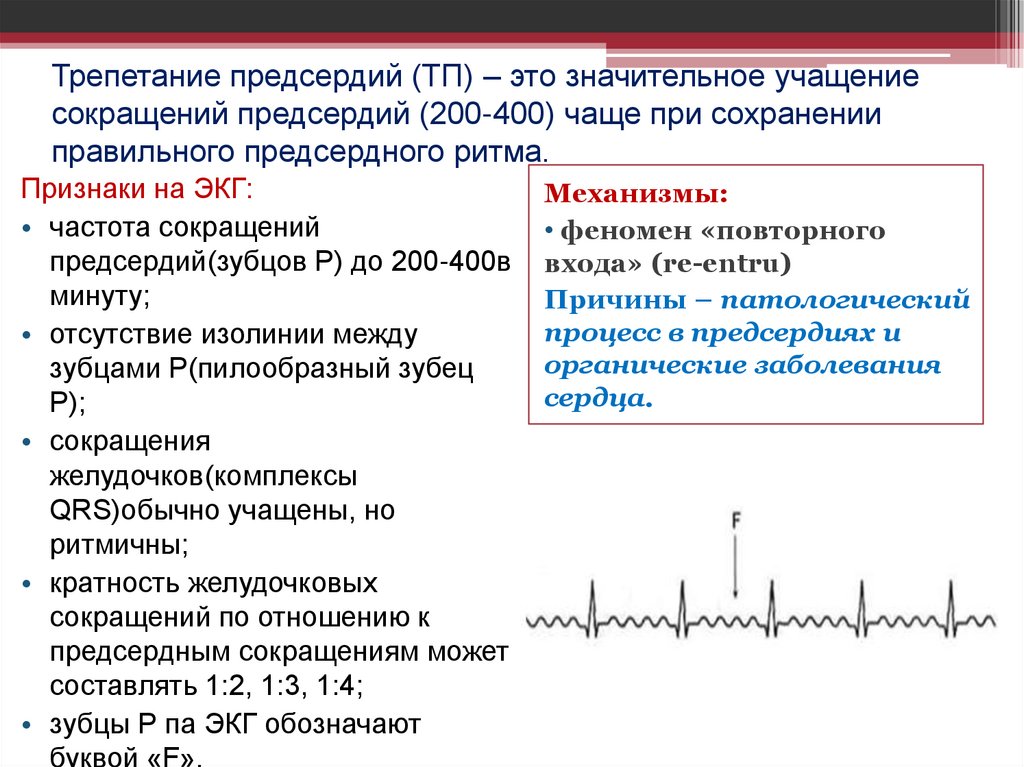 Трепетание предсердий (ТП) – это значительное учащение сокращений предсердий (200-400) чаще при сохранении правильного