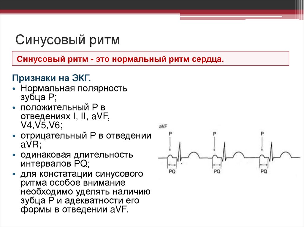 Синусовый ритм