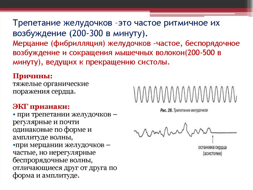 Трепетание желудочков –это частое ритмичное их возбуждение (200-300 в минуту). Мерцание (фибрилляция) желудочков –частое,
