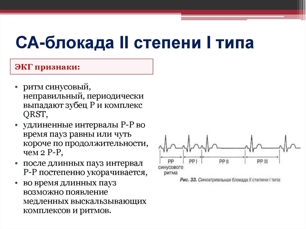 СА-блокада II степени I типа