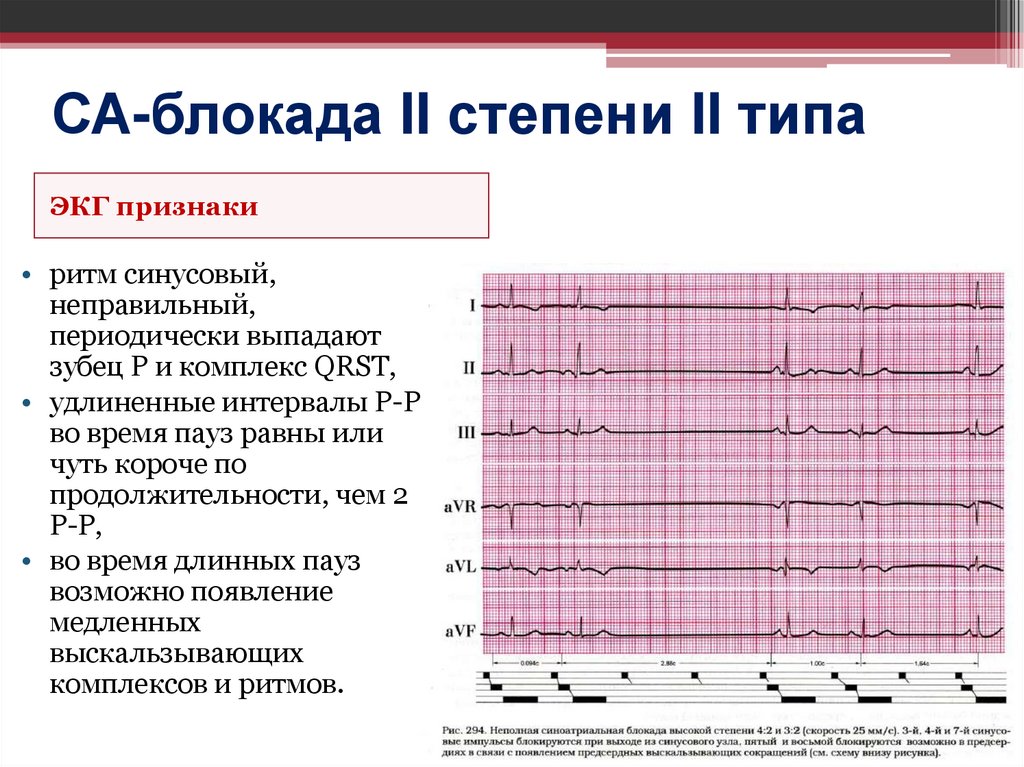 СА-блокада II степени II типа