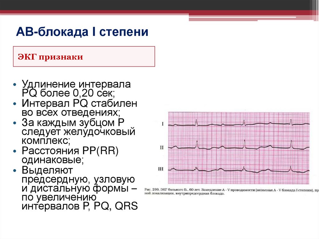 АВ-блокада I степени