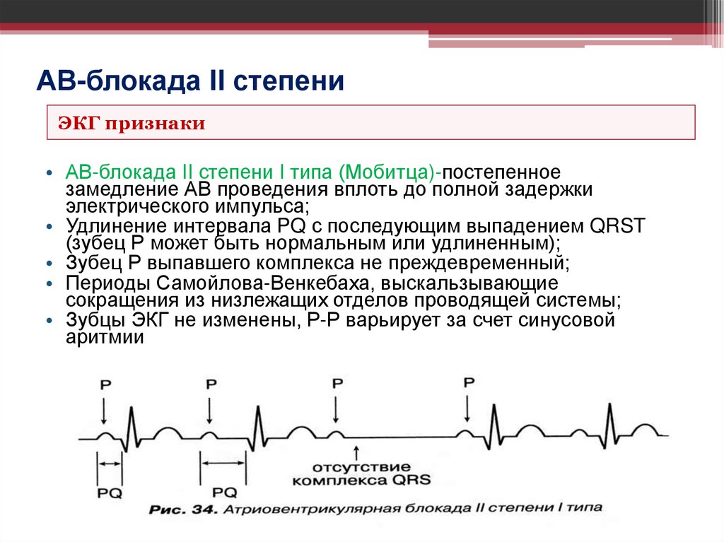 АВ-блокада II степени