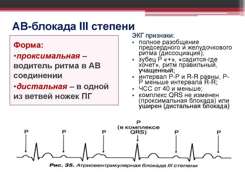 АВ-блокада III степени