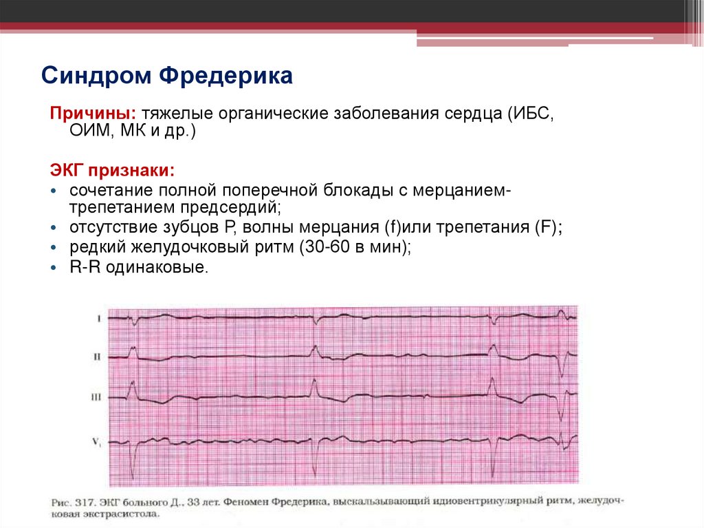 Синдром Фредерика
