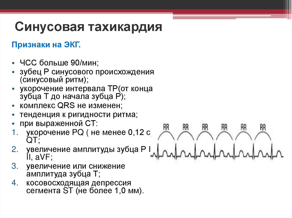 Синусовая тахикардия