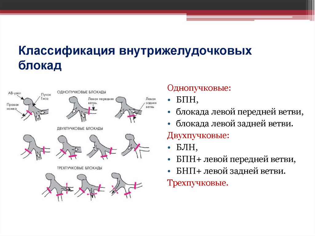Классификация внутрижелудочковых блокад