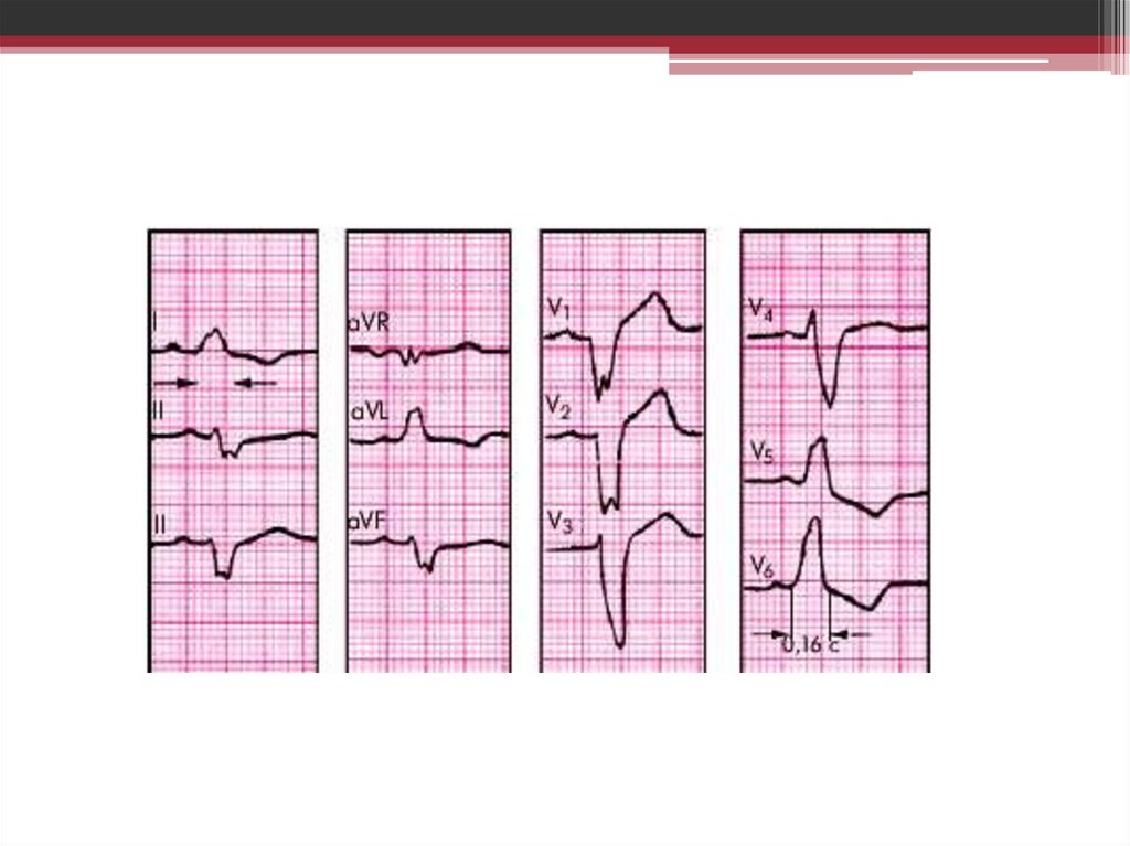 Полная блокада левой ножки пучка Гиса