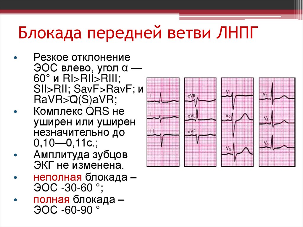 Неполная блокада левой ножки пучка Гиса