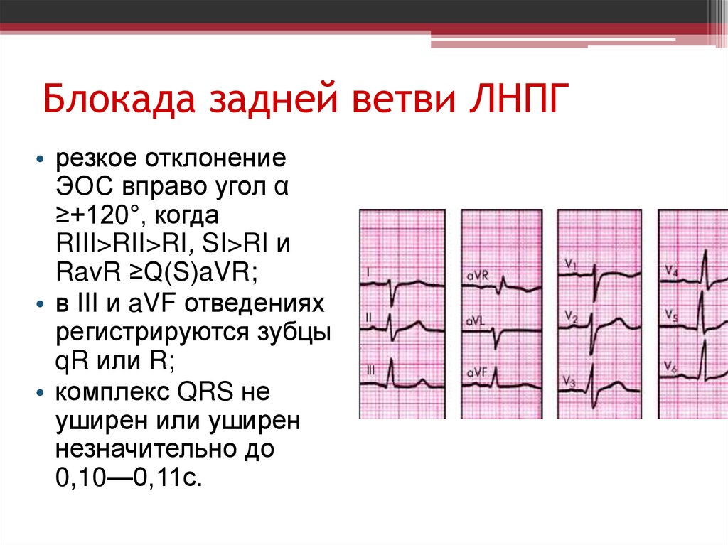 Блокада передней ветви ЛНПГ