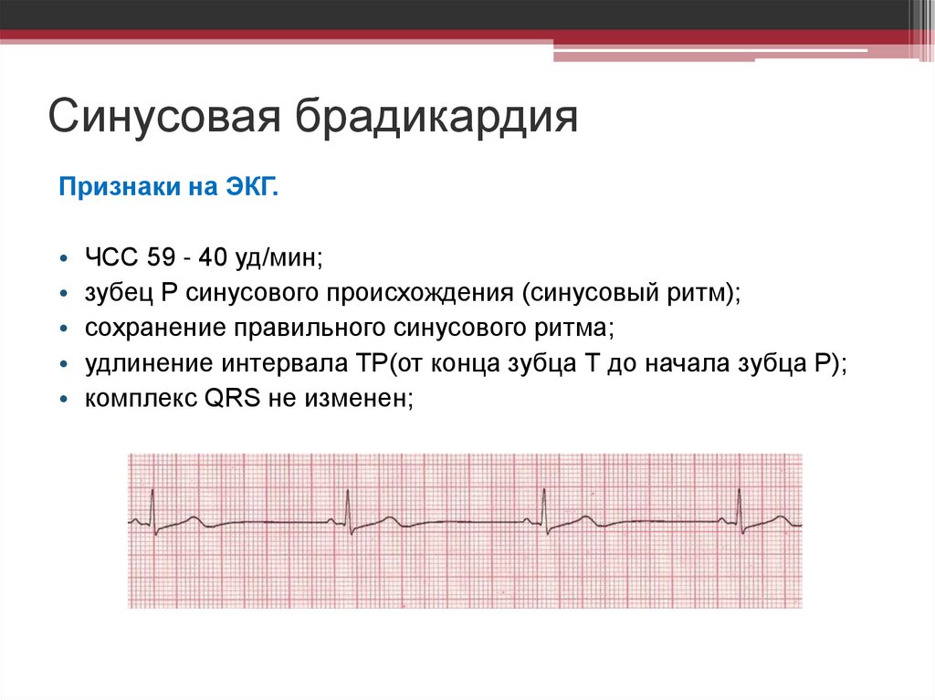Синусовая брадикардия