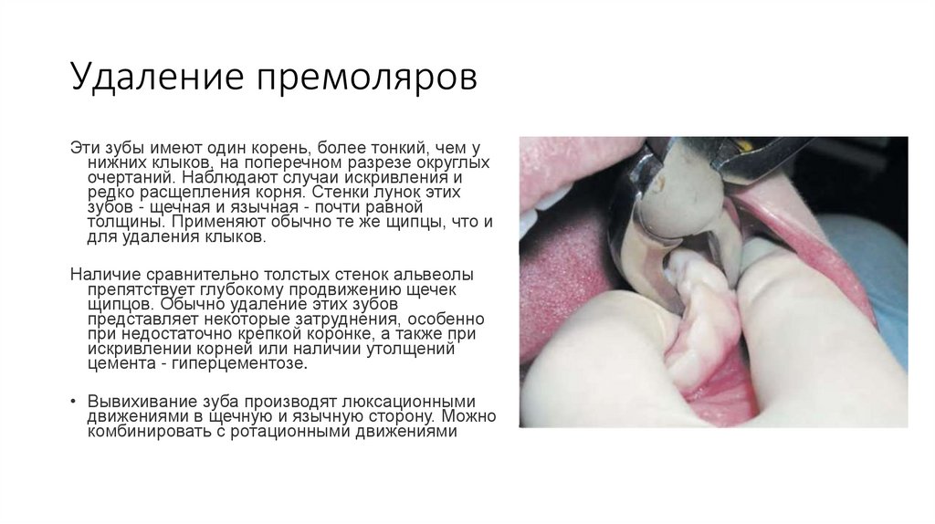 Удаление премоляров