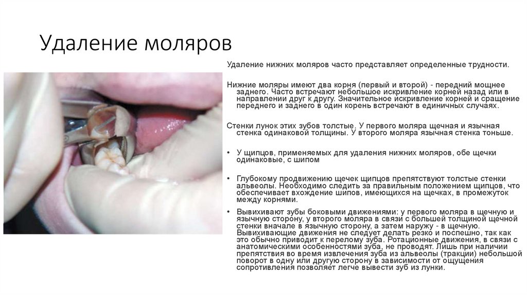 Удаление моляров
