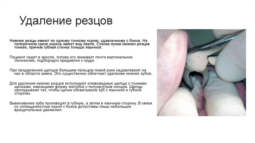Удаление резцов