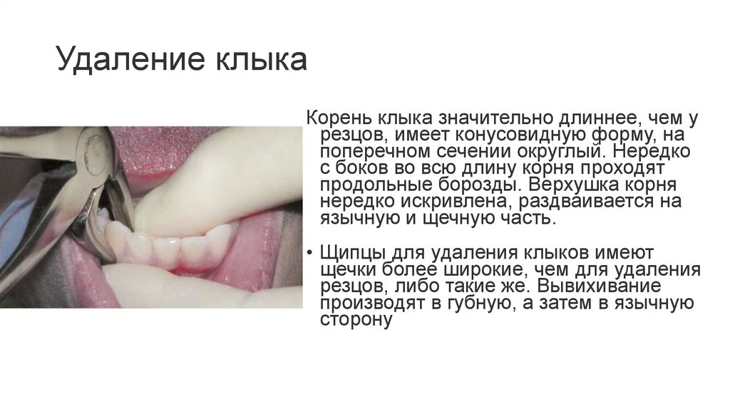 Удаление клыка