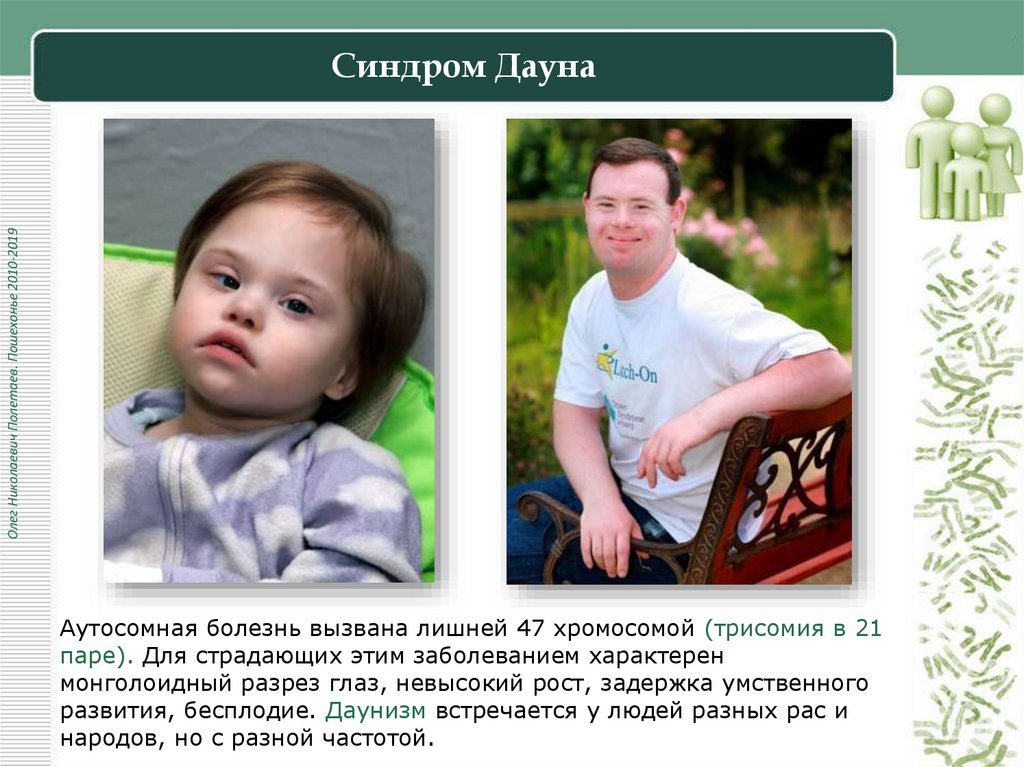 Синдром Дауна