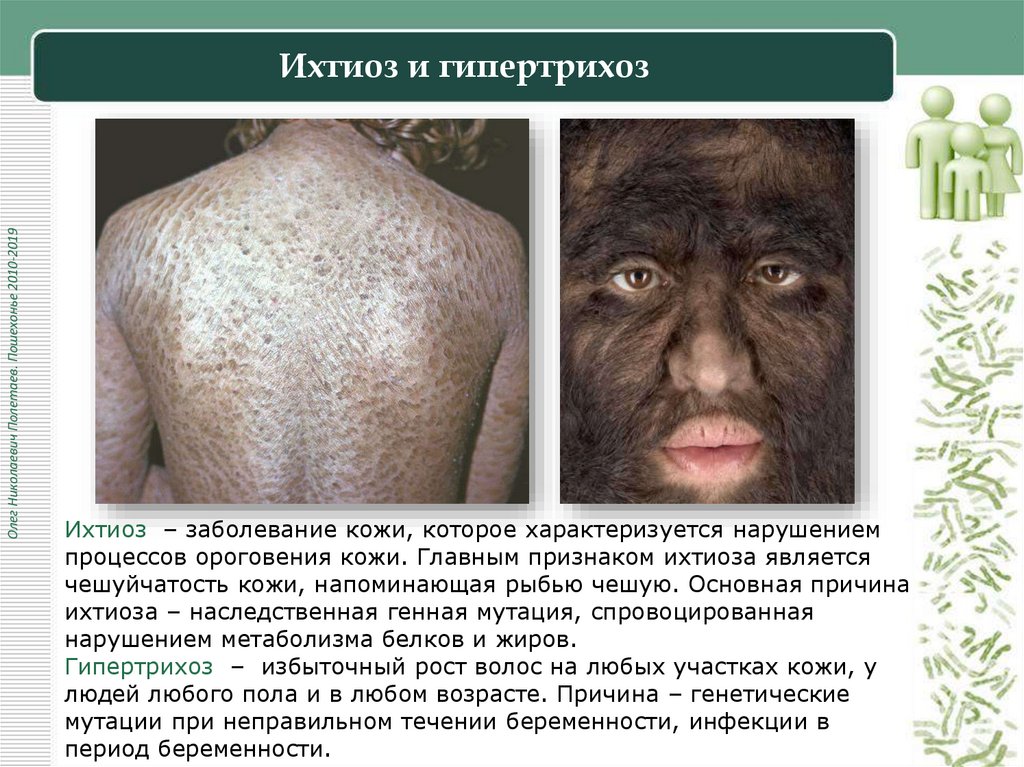 Ихтиоз и гипертрихоз