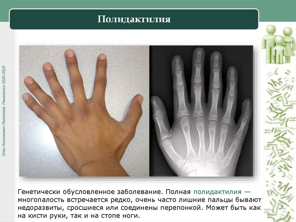 Полидактилия