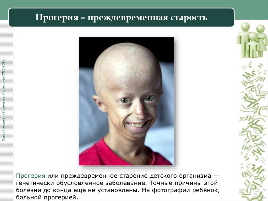 Прогерия – преждевременная старость
