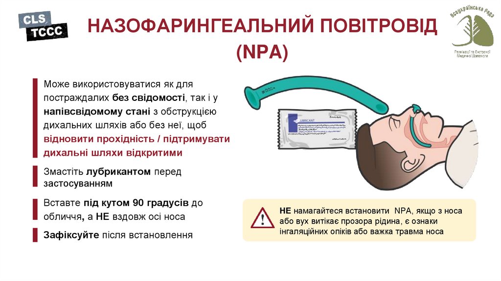НАЗОФАРИНГЕАЛЬНИЙ ПОВІТРОВІД (NPA)