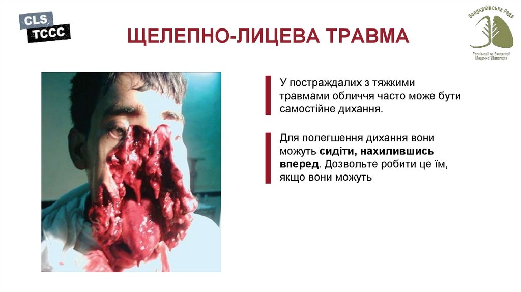 ЩЕЛЕПНО-ЛИЦЕВА ТРАВМА