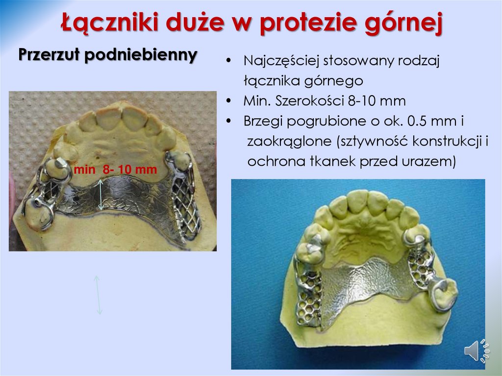 Łączniki duże w protezie górnej