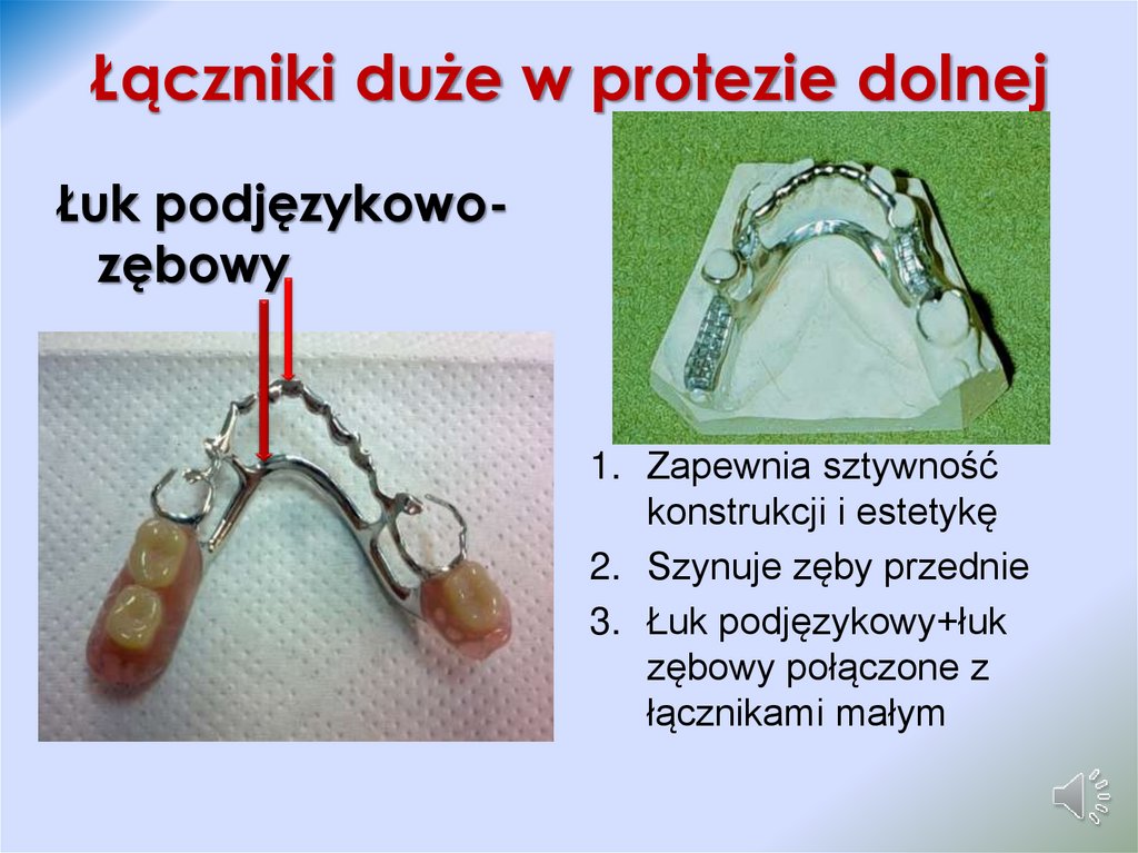 Łączniki duże w protezie dolnej