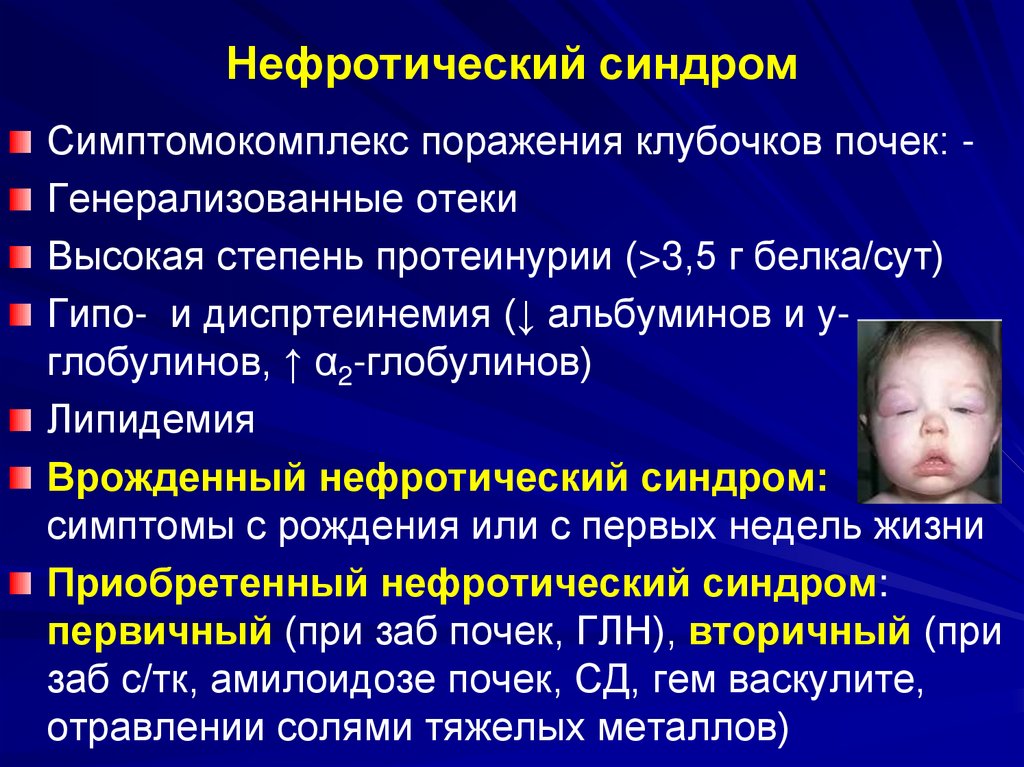 Нефротический синдром