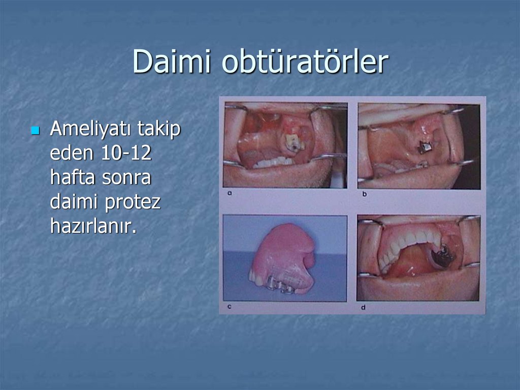 Daimi obtüratörler