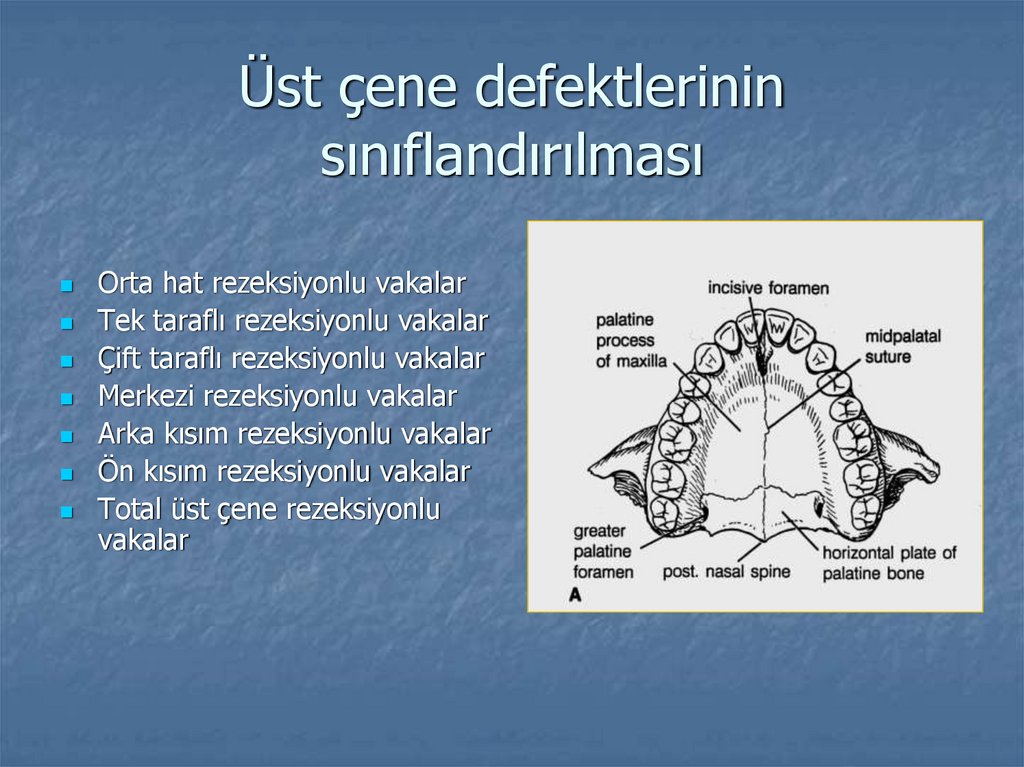 Üst çene defektlerinin sınıflandırılması