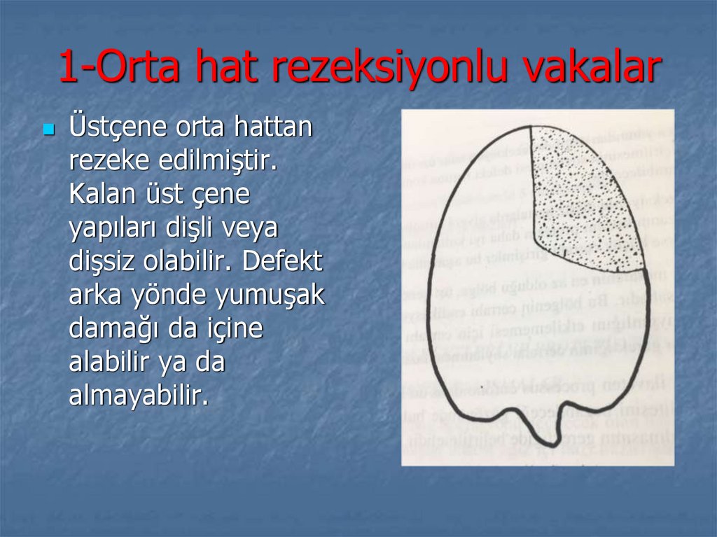 1-Orta hat rezeksiyonlu vakalar