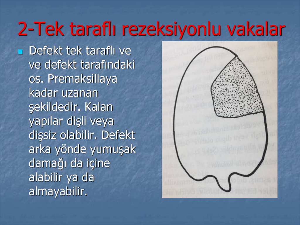2-Tek taraflı rezeksiyonlu vakalar