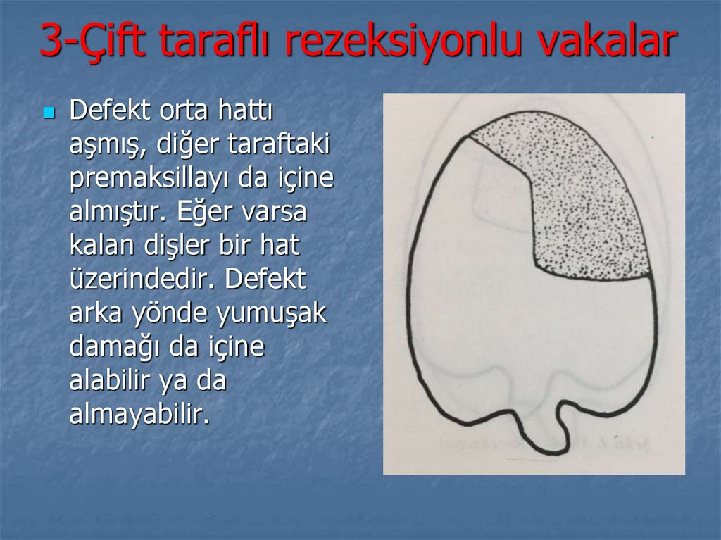 3-Çift taraflı rezeksiyonlu vakalar