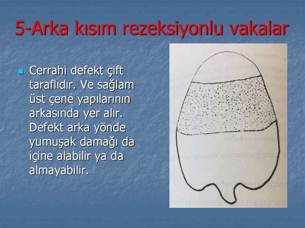 5-Arka kısım rezeksiyonlu vakalar