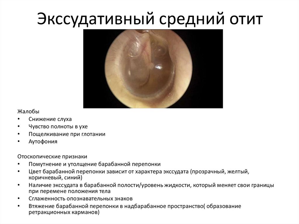 Экссудативный средний отит