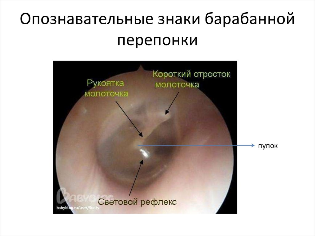 Опознавательные знаки барабанной перепонки