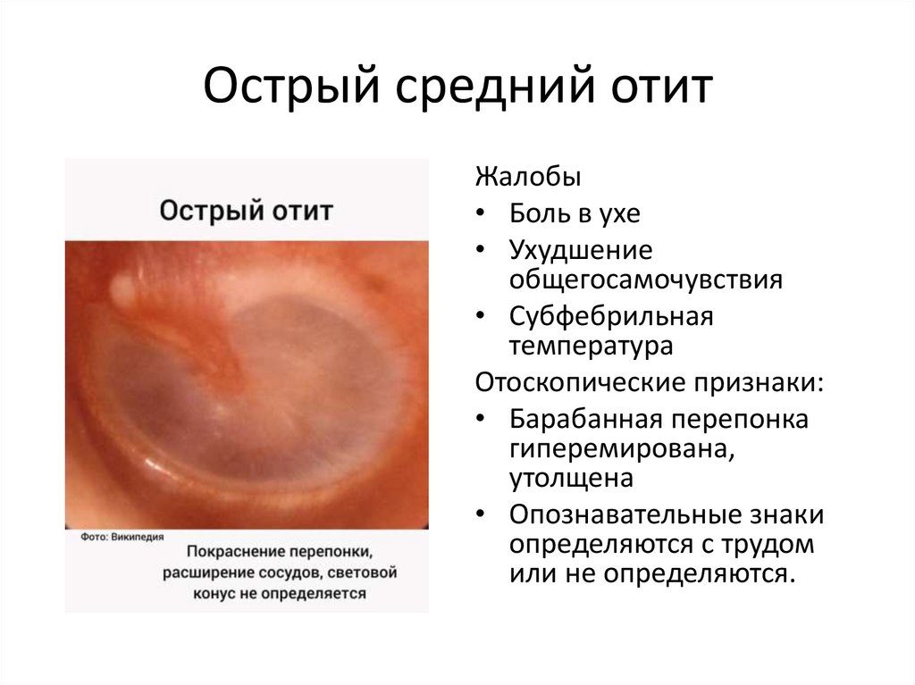 Острый средний отит