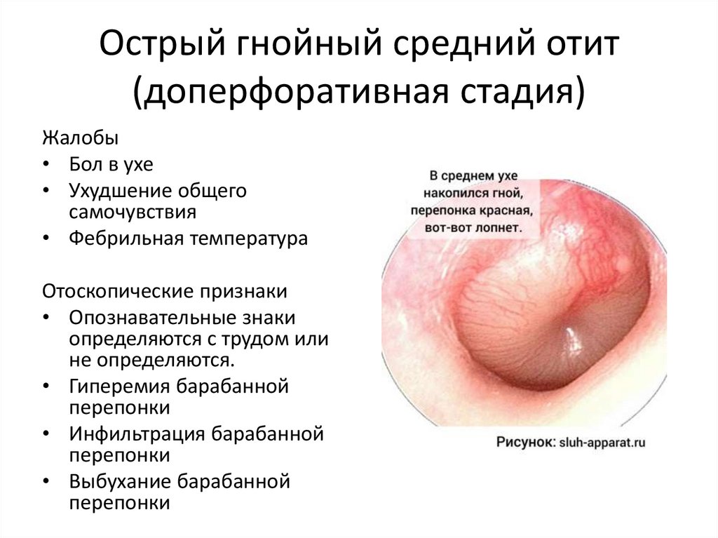 Острый гнойный средний отит (доперфоративная стадия)