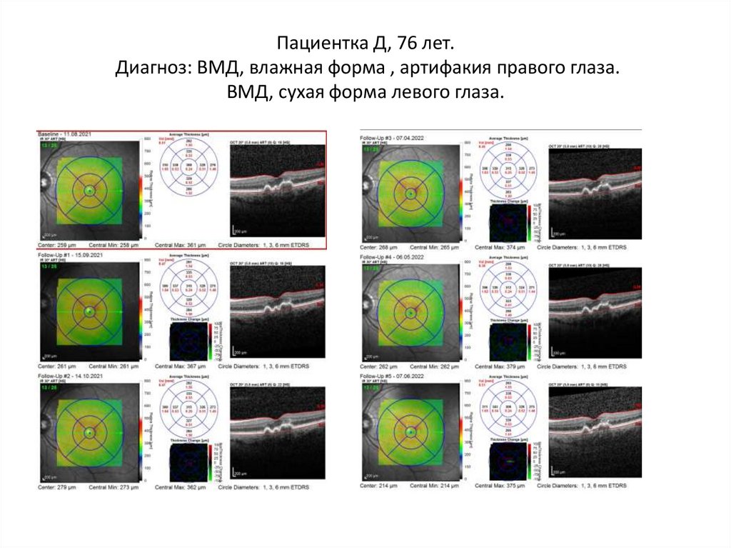 Пациентка Д, 76 лет. Диагноз: ВМД, влажная форма , артифакия правого глаза. ВМД, сухая форма левого глаза.
