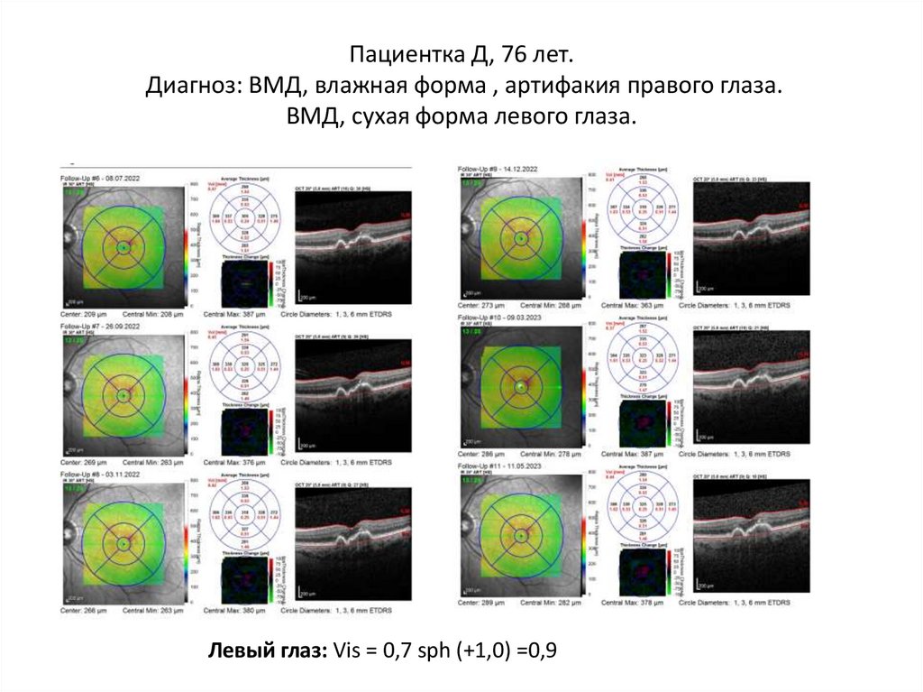 Пациентка Д, 76 лет. Диагноз: ВМД, влажная форма , артифакия правого глаза. ВМД, сухая форма левого глаза.
