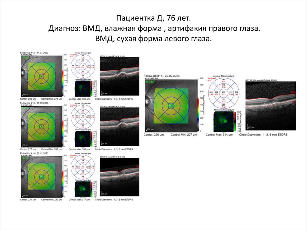 Пациентка Д, 76 лет. Диагноз: ВМД, влажная форма , артифакия правого глаза. ВМД, сухая форма левого глаза.