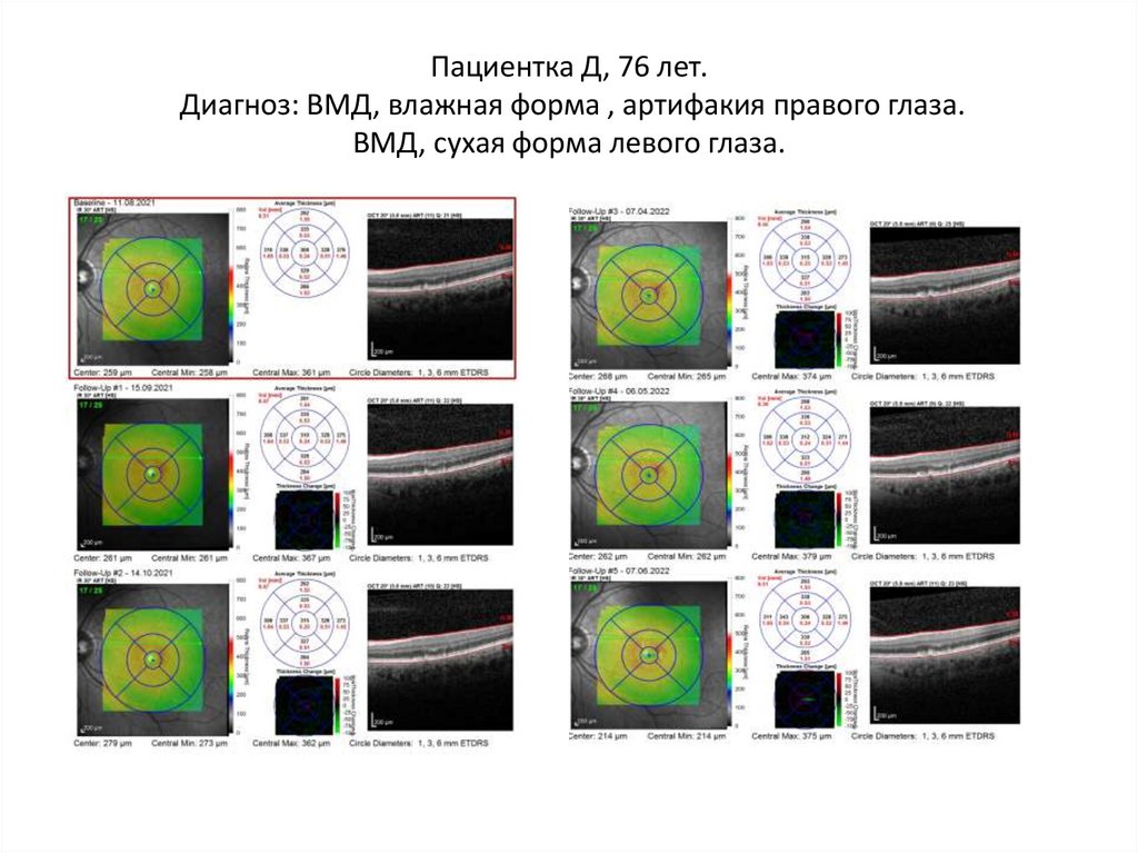 Пациентка Д, 76 лет. Диагноз: ВМД, влажная форма , артифакия правого глаза. ВМД, сухая форма левого глаза.