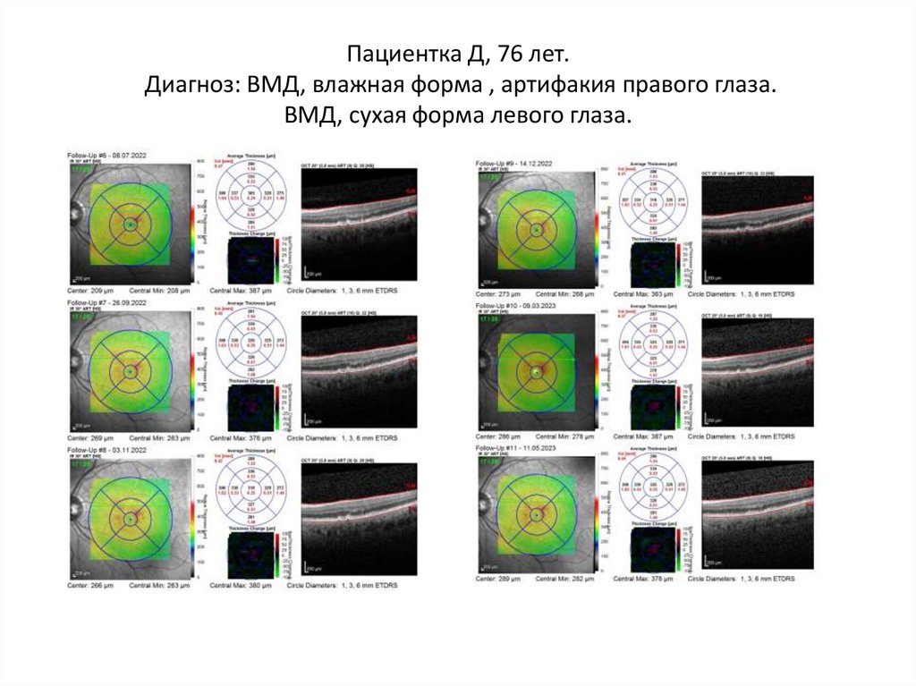 Пациентка Д, 76 лет. Диагноз: ВМД, влажная форма , артифакия правого глаза. ВМД, сухая форма левого глаза.