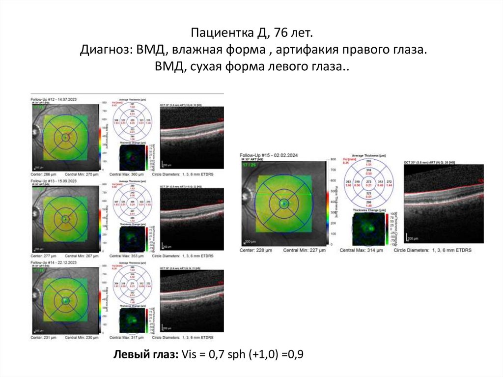 Пациентка Д, 76 лет. Диагноз: ВМД, влажная форма , артифакия правого глаза. ВМД, сухая форма левого глаза..