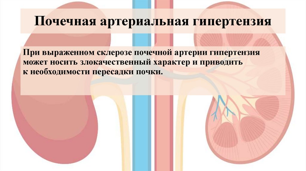Почечная артериальная гипертензия