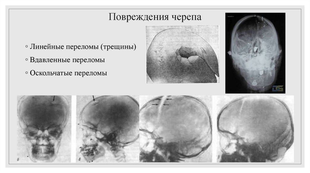 Повреждения черепа